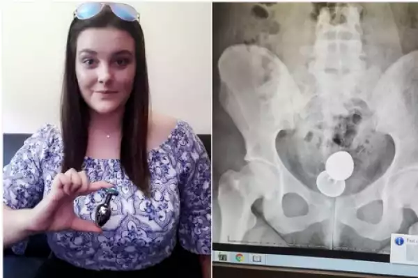 Woman Undergoes Surgery To Remove Sex Toy Stuck In Her Bottom. Photos